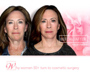 before and after photo of woman who had facelift