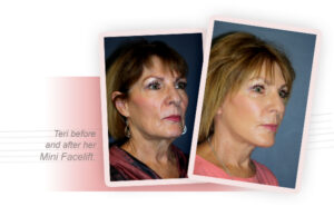 smith cosmetic surgery patient mini facelift before and after