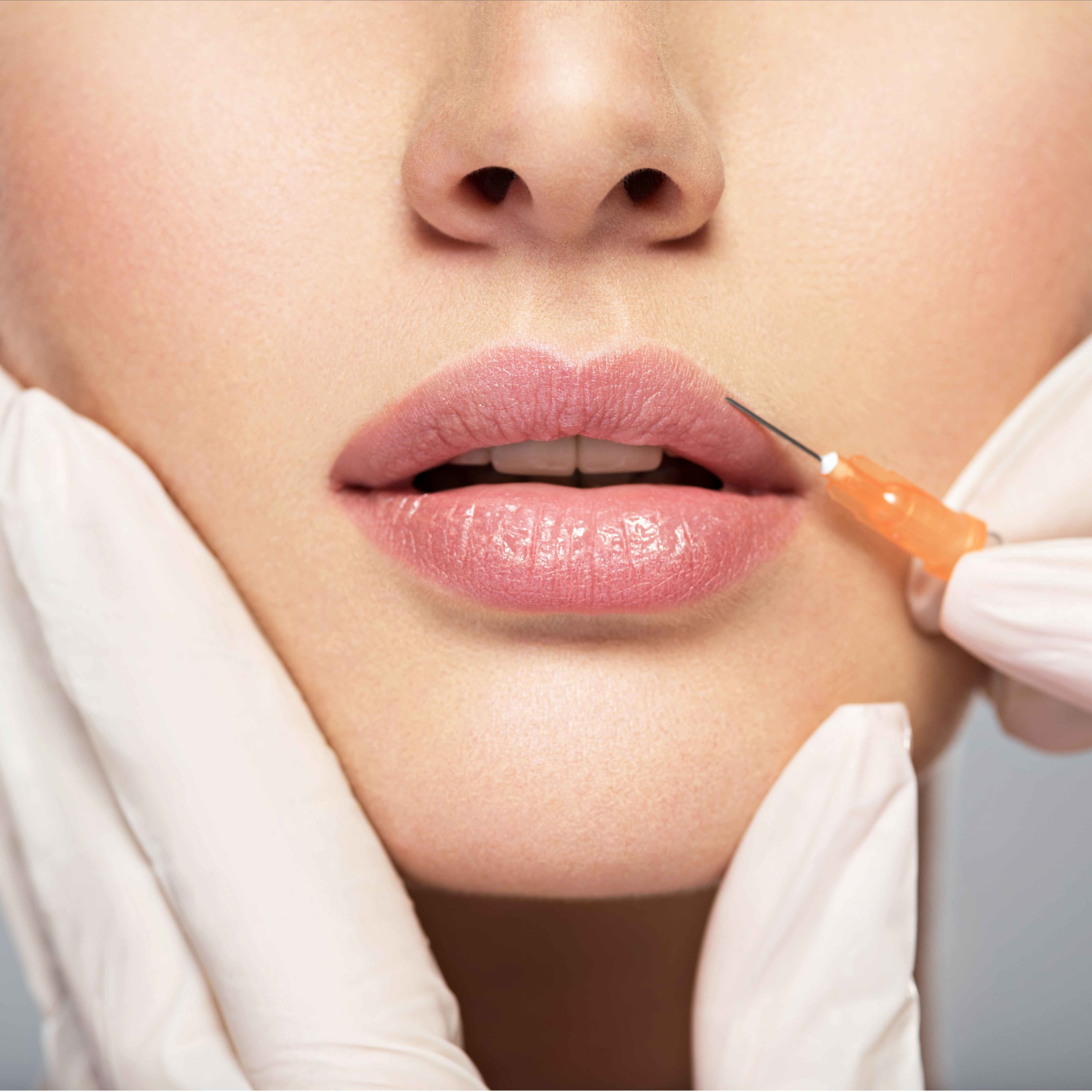 Lip Dermal Fillers-Centennial-Colorado-Co