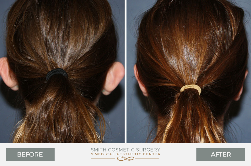 Before And After Gallery Of Ear Surgery-c-CO-Smith Cosmetic Surgery