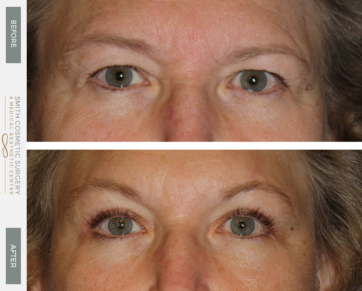 Before-And-After-Gallery-Of-Eyes-And-Brows-One-CO-Smith-Cosmetic-Surgery