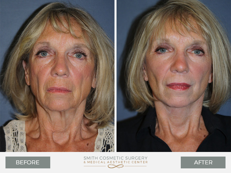 Before-And-After-Gallery-Of-Mini-Lift-Five-CO-Smith-Cosmetic-Surgery
