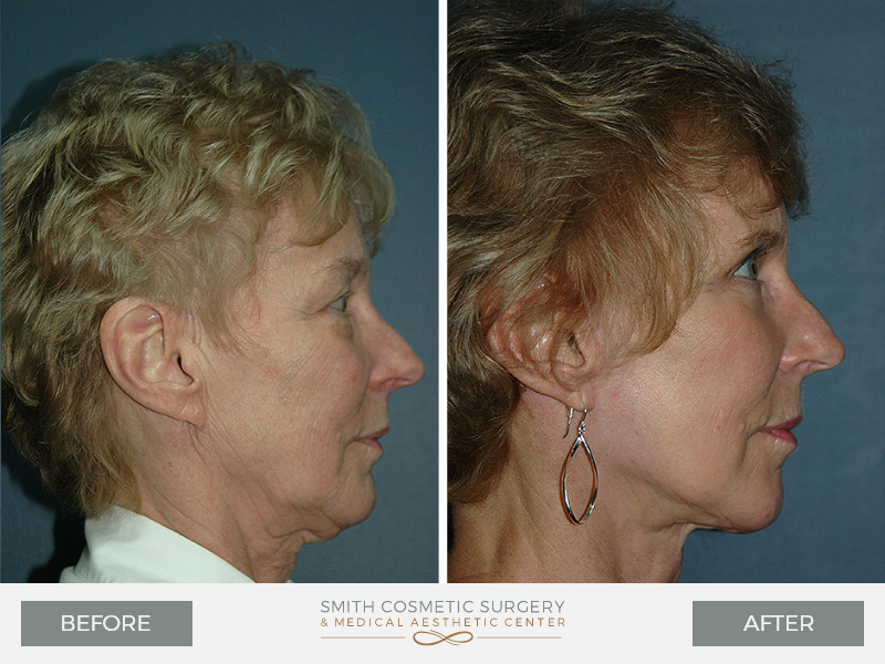 Before And After Gallery Of Mini Lift-Two-CO-Smith Cosmetic Surgery