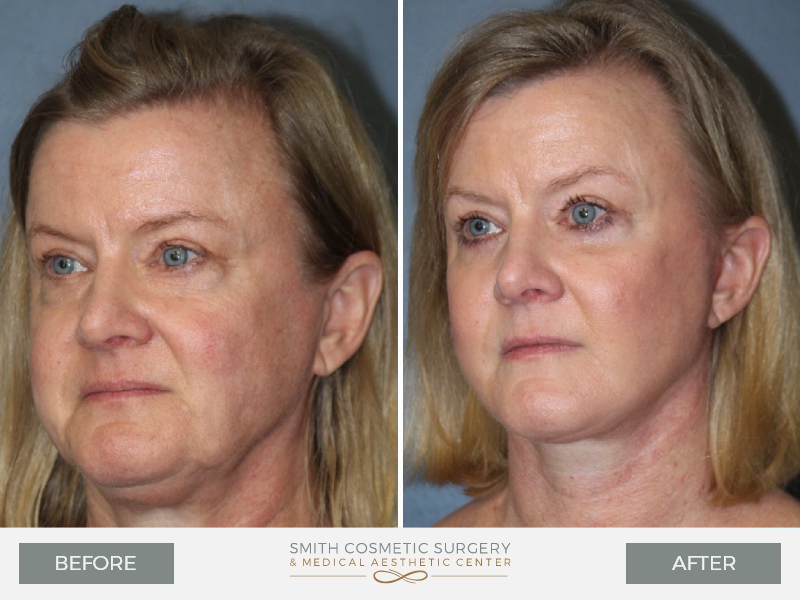 mini facelift - before and after