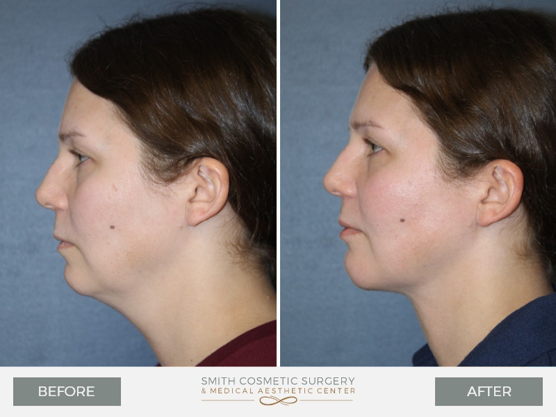 Chin surgery - before and after