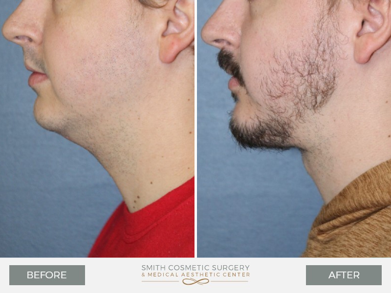 Chin surgery - before and after