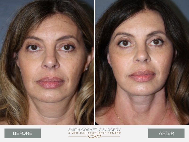 1-face-lift-before-after-.jpg