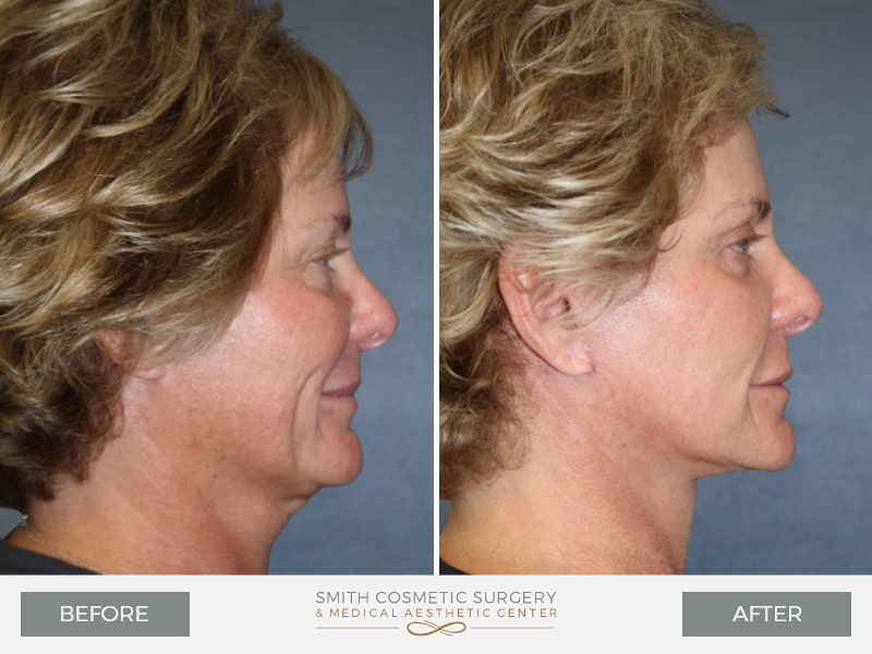 6-face-lift-before-after.jpg