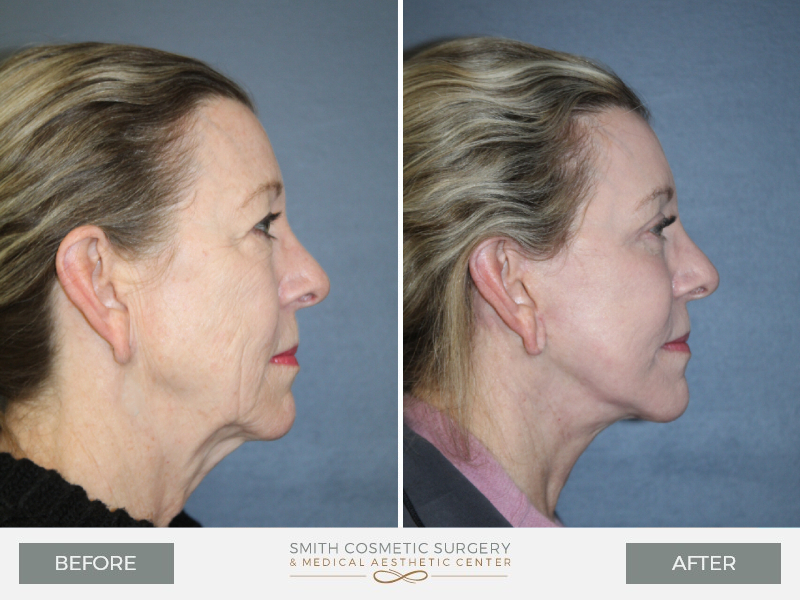 Before_and_After_AD_Facelift_rt-lat.jpg