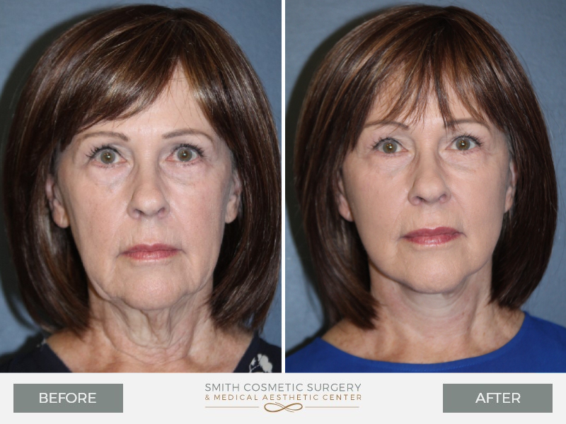 Before_and_After_MC_Facelift_front.jpg