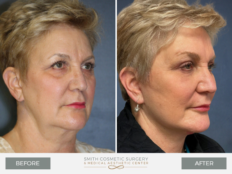 Before_and_After_TS_Facelift-ob.jpg