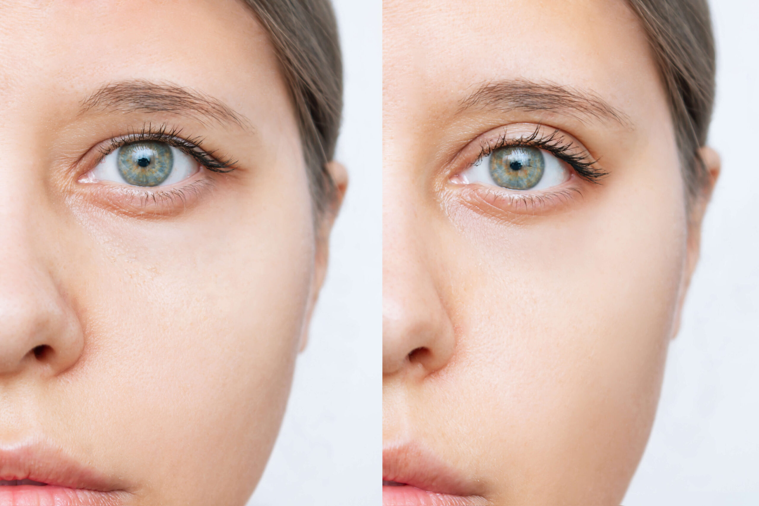 DENVER-EYELID-LIFTS-AND-BROW-LIFTS