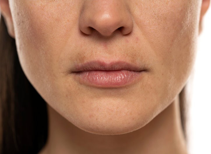 HYPERPIGMENTED LESION TREATMENT