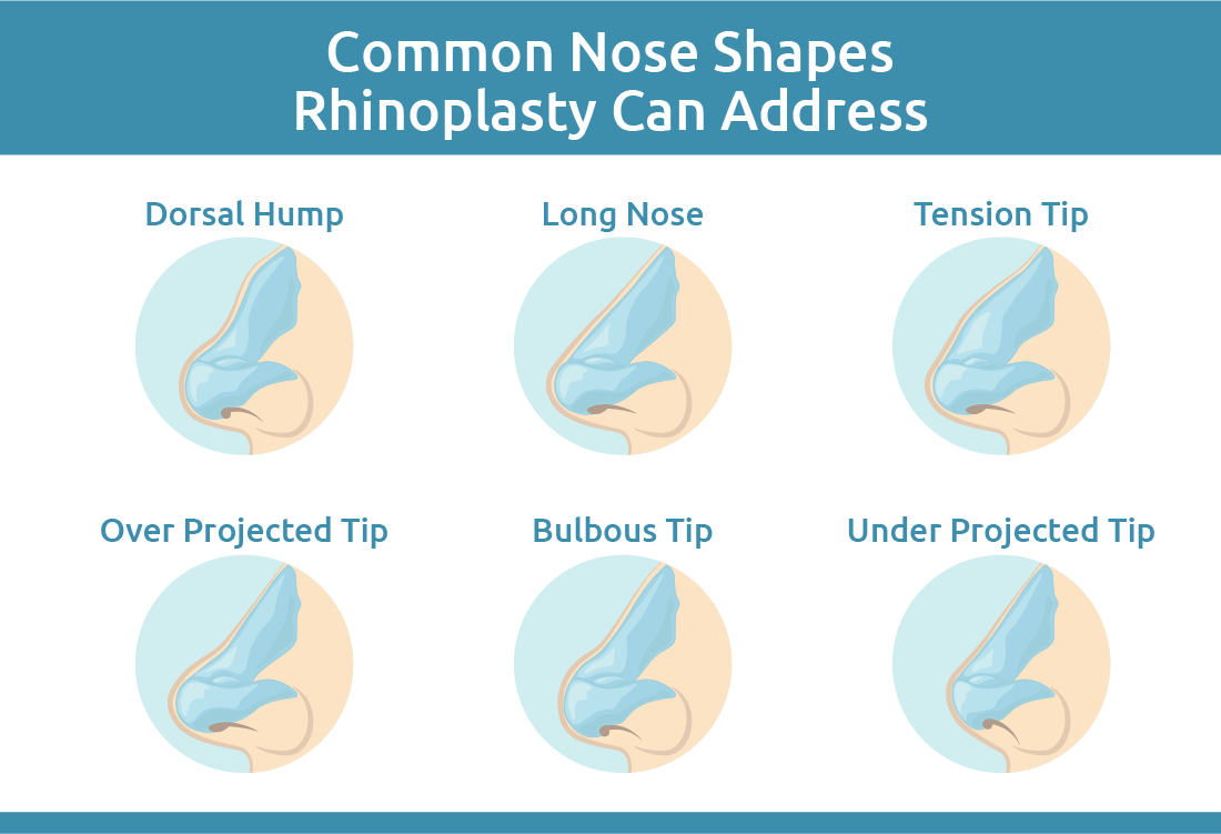 Rhinoplasty Benefits