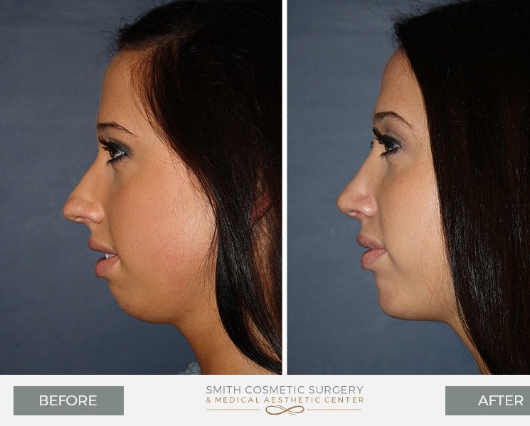 Nose-Surgery-3.jpg