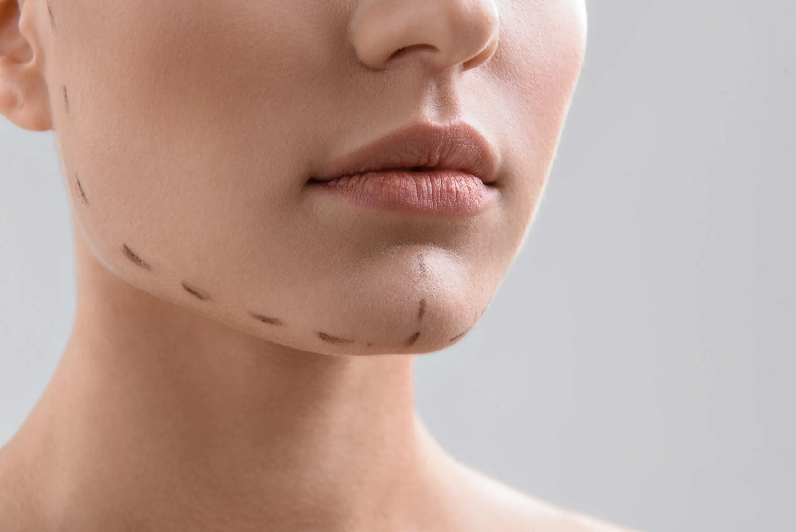 Chin surgery recovery and results