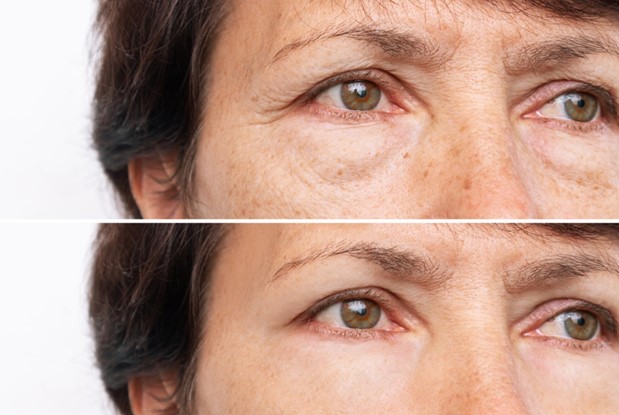 Undereye Bags: What Causes Them and How to Get Rid of Them