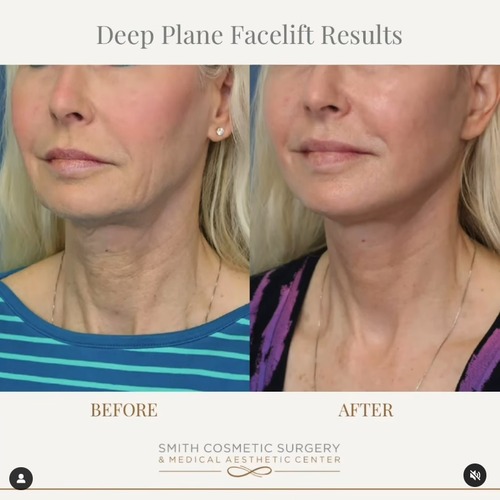 deep plane facelift results