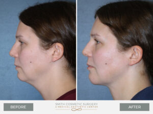 Woman before and after cosmetic surgery with defined jawline.