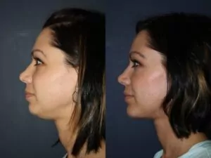 before and after of plastic surgery to resolve a double chin