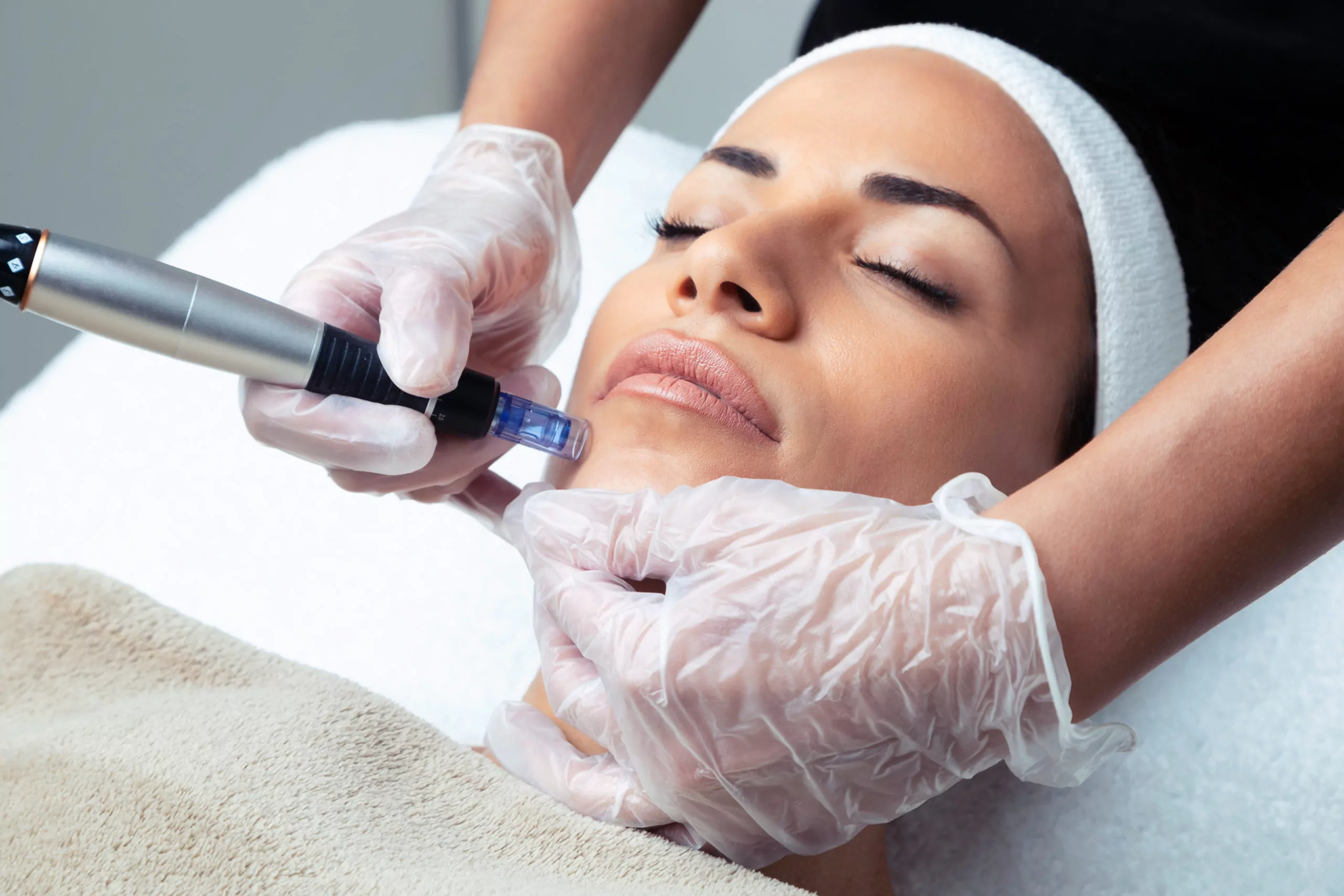 MICRONEEDLING -Centennial, CO