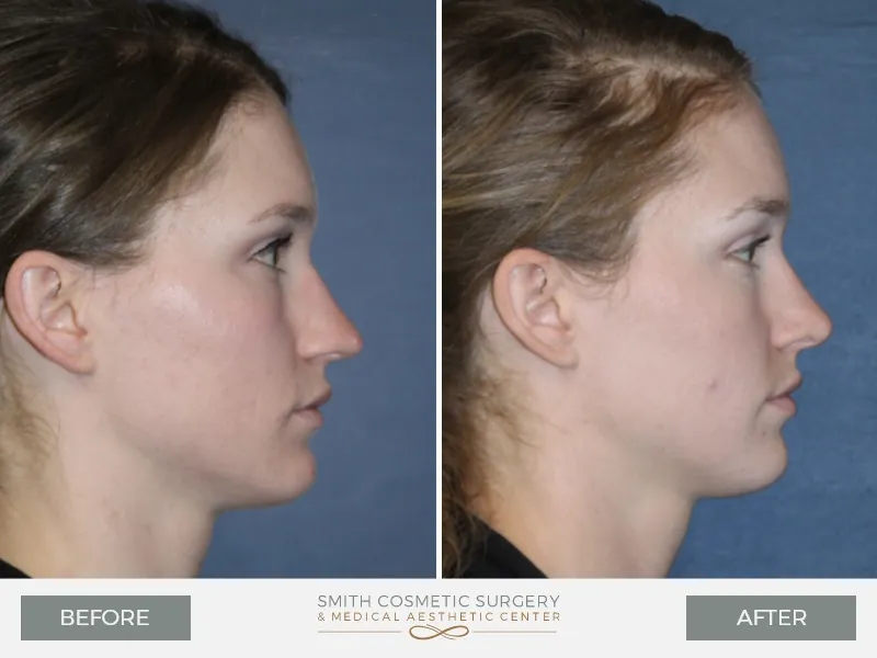 01-Rhinoplasty-Before-and-After.jpg