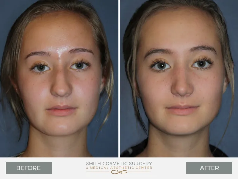 01-Rhinoplasty.jpg