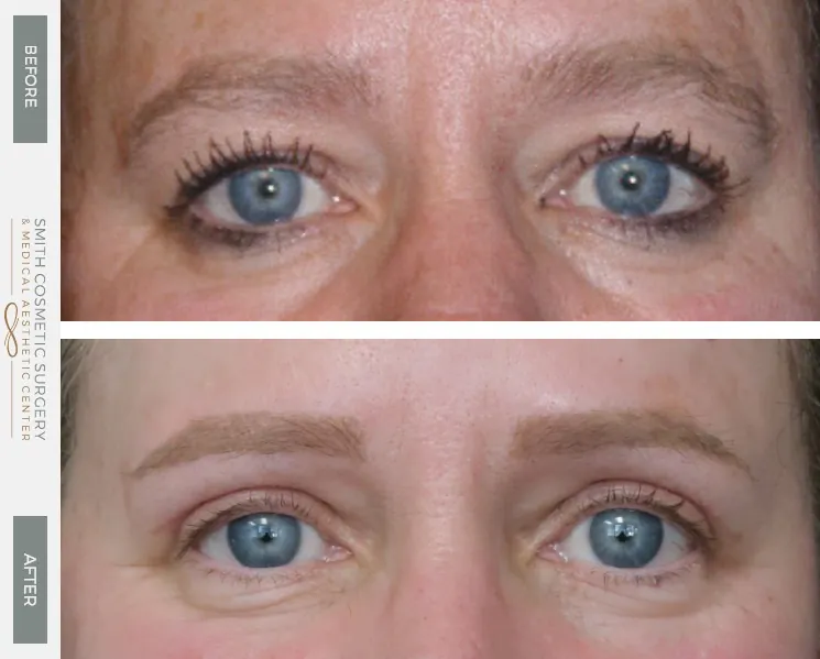01_Eyelid-Lift-and-Brow-Lift_before_after.jpg