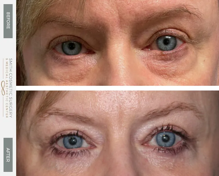 01_Eyelids-and-Brow-Lift.jpg