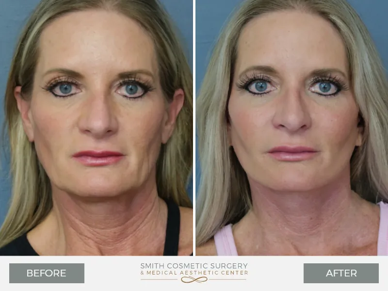01_Facelift.jpg