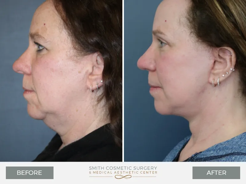 01_Facelift_before_after-1.jpg