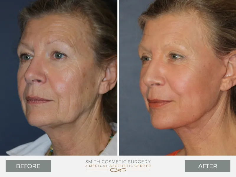 01_Laser_Resurfacing_Before_After.jpg
