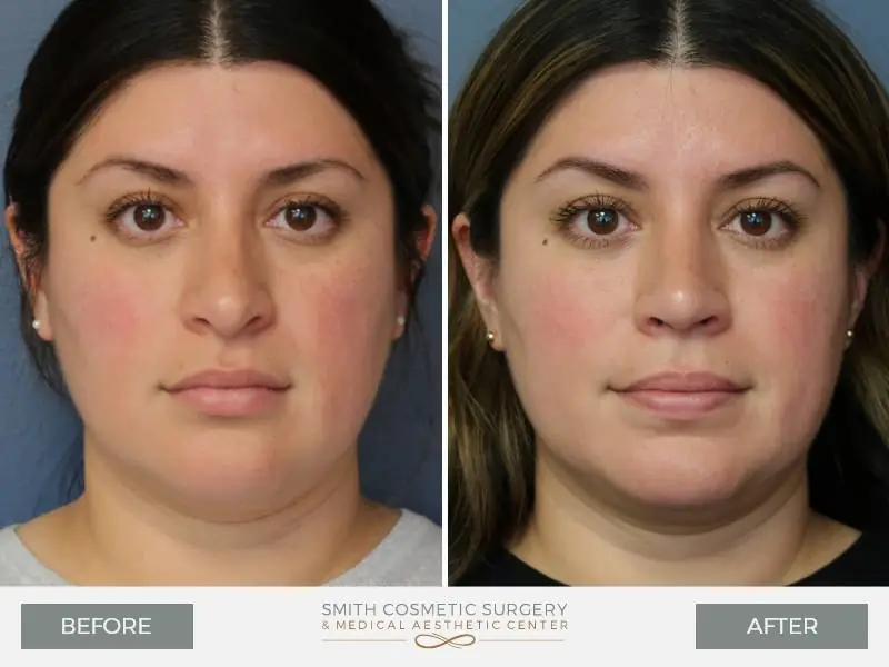 01_Rhinoplasty_Before_After-1.jpg