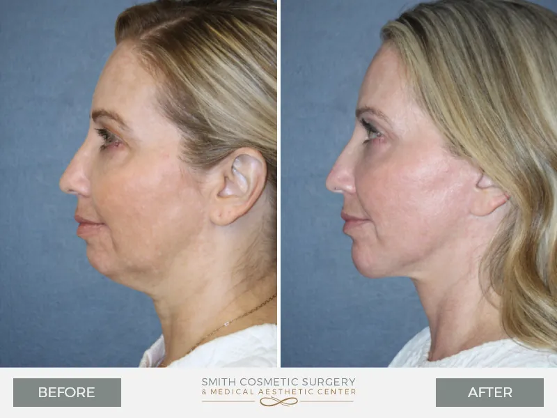 01_chin_surgery_before_and_after.jpg
