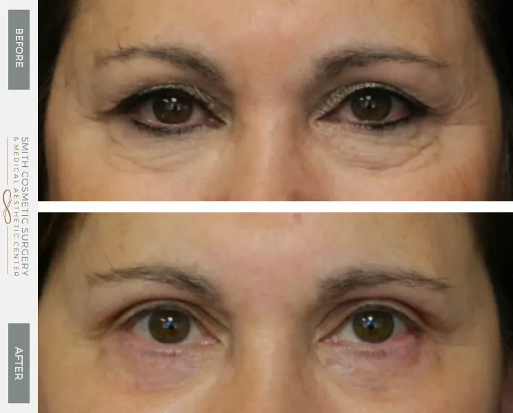 01_eyes_and_brow_before-after.jpg