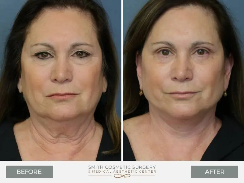 01_facelift_before_after.jpg