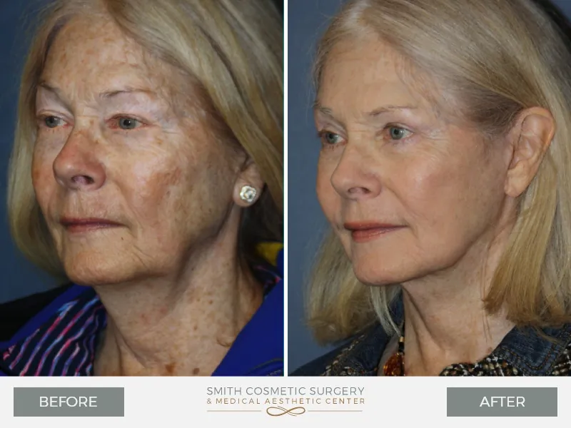 01_laser_resurfacing_before_and_after.jpg