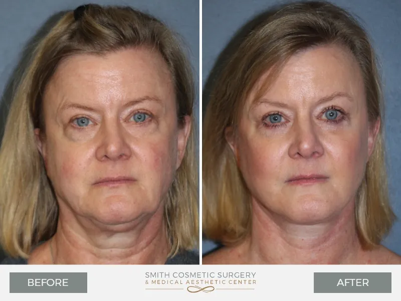 01_mini_facelift_before_and_after.jpg