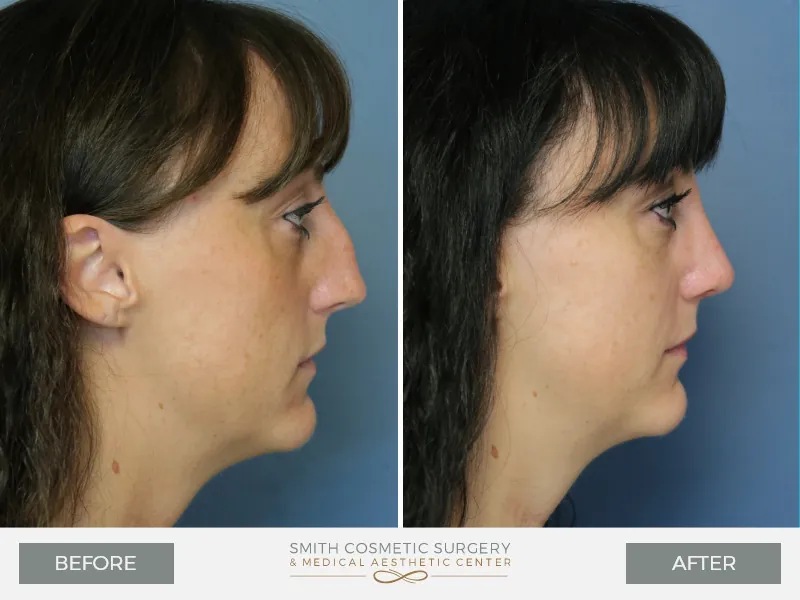 02-Rhinoplasty-Before-and-After.jpg