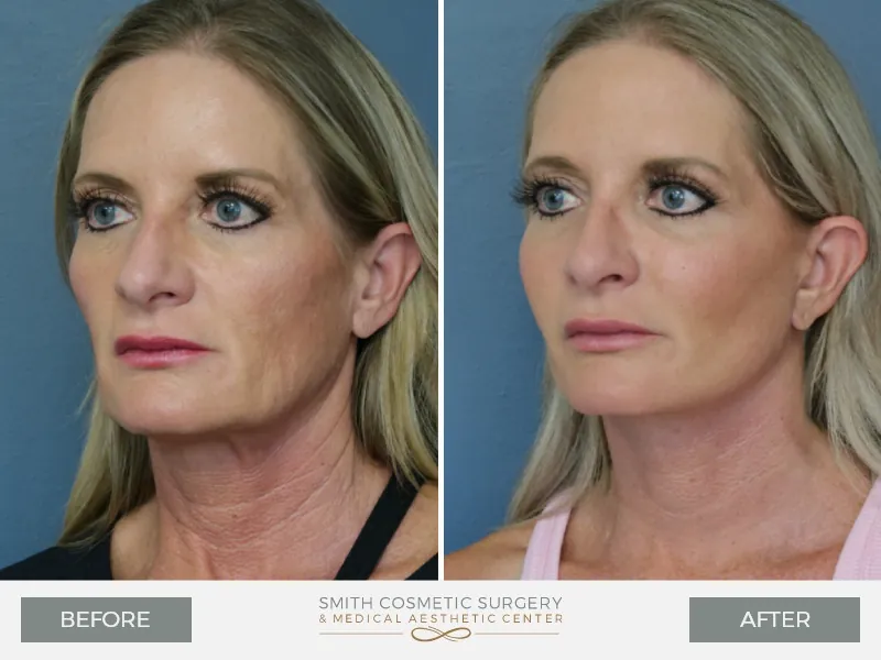 02_Facelift.jpg