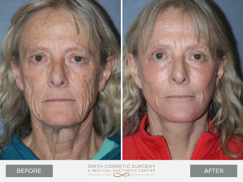 02_Laser_Resurfacing_Before_After.jpg