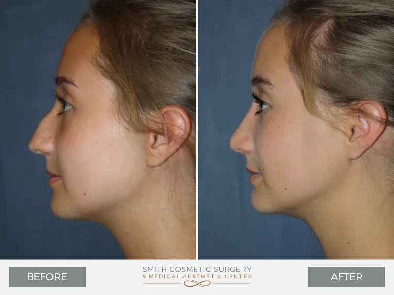 02_Rhinoplasty.jpg