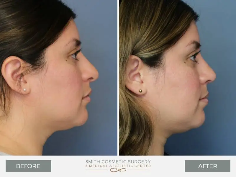 02_Rhinoplasty_Before_After-1.jpg