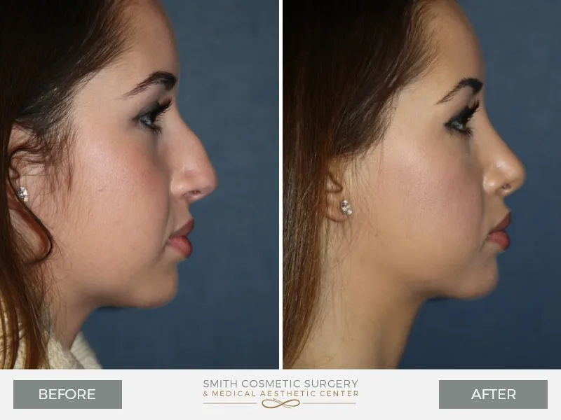 02_Rhinoplasty_Before_After.jpg