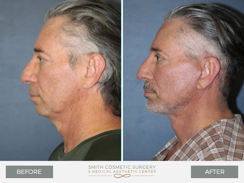 02_chin_surgery_before_and_after.jpg