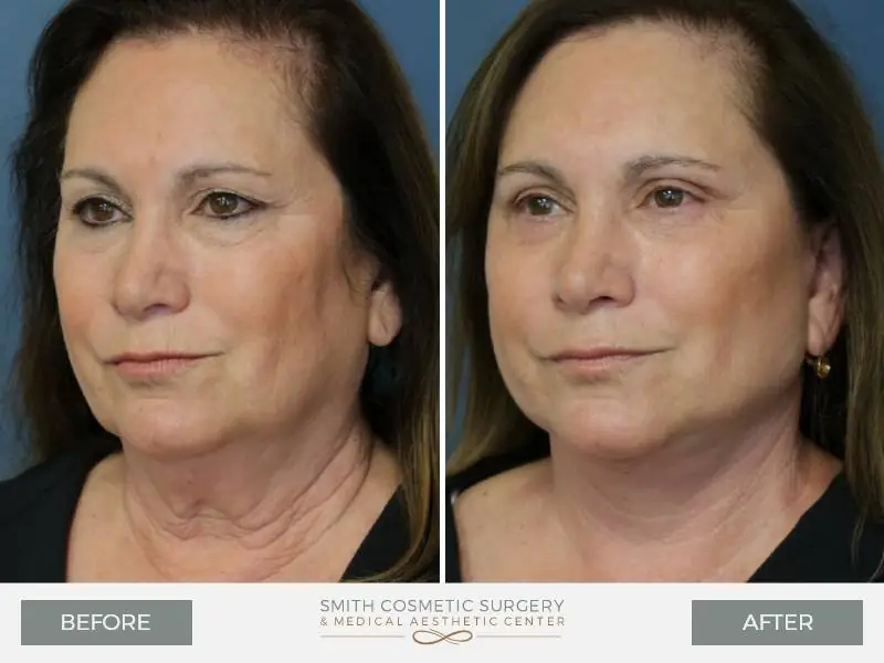 02_facelift_before_after.jpg