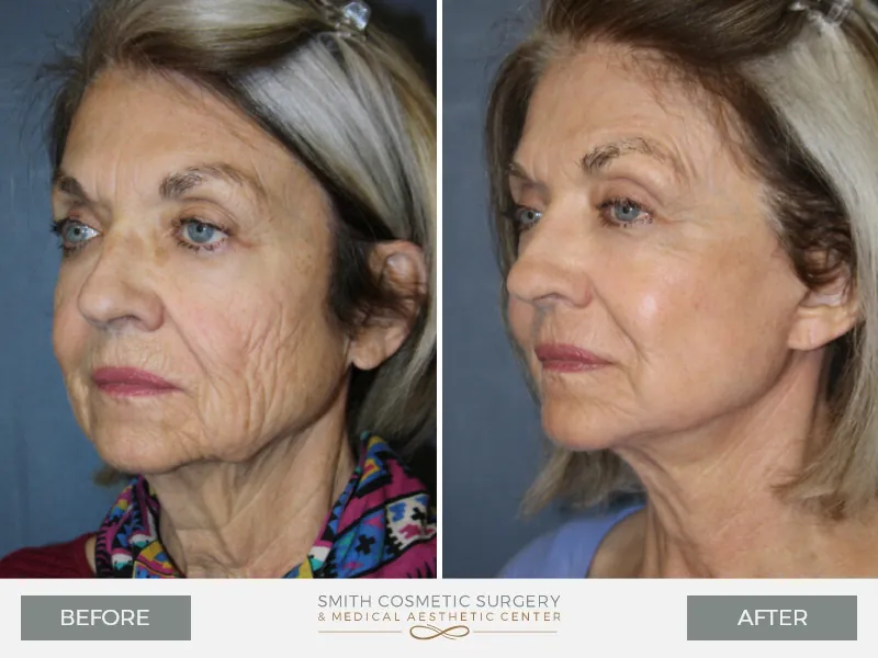 02_laser_resurfacing_before_and_after.jpg