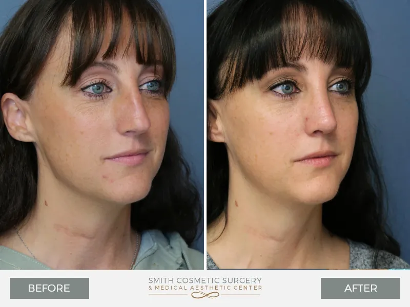03-Rhinoplasty-Before-and-After.jpg