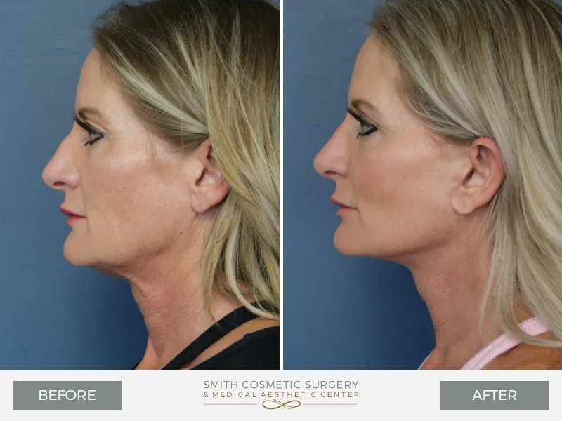 03_Facelift.jpg
