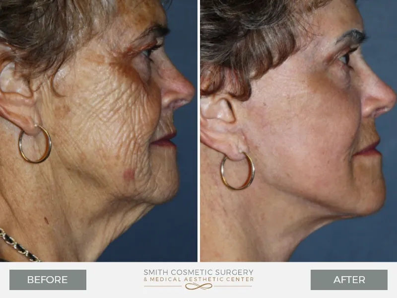 03_laser_resurfacing_before_and_after.jpg